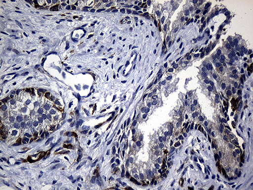 R1 / RRM1 Antibody - Immunohistochemical staining of paraffin-embedded Human prostate tissue within the normal limits using anti-RRM1 mouse monoclonal antibody. (Heat-induced epitope retrieval by 1mM EDTA in 10mM Tris buffer. (pH8.5) at 120°C for 3 min. (1:500)