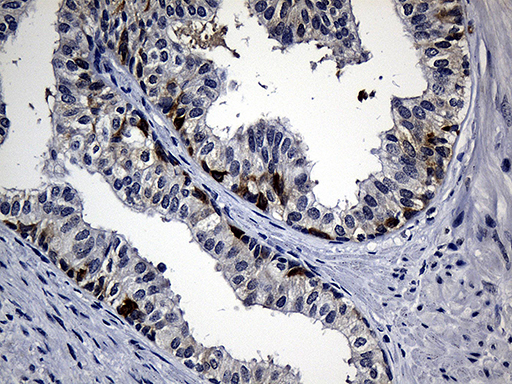 R1 / RRM1 Antibody - Immunohistochemical staining of paraffin-embedded Carcinoma of Human prostate tissue using anti-RRM1 mouse monoclonal antibody. (Heat-induced epitope retrieval by 1mM EDTA in 10mM Tris buffer. (pH8.5) at 120°C for 3 min. (1:500)