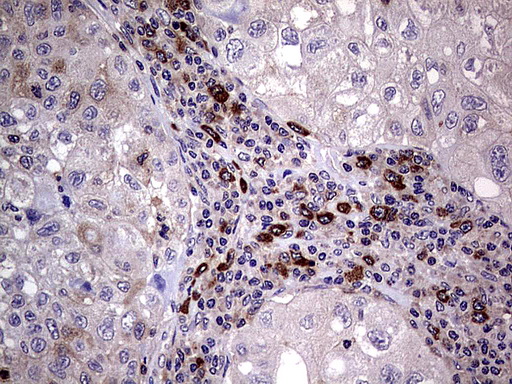 R1 / RRM1 Antibody - Immunohistochemical staining of paraffin-embedded Carcinoma of Human lung tissue using anti-RRM1 mouse monoclonal antibody.  heat-induced epitope retrieval by 1 mM EDTA in 10mM Tris, pH8.5, 120C for 3min)