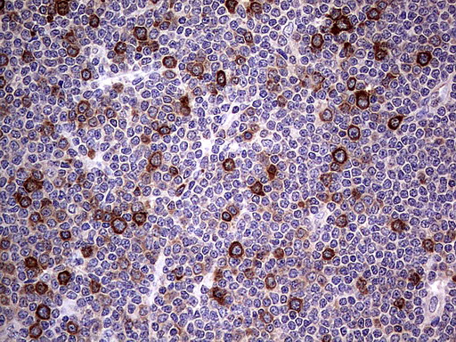 R1 / RRM1 Antibody - Immunohistochemical staining of paraffin-embedded Human lymphoma tissue using anti-RRM1 mouse monoclonal antibody.  heat-induced epitope retrieval by 1 mM EDTA in 10mM Tris, pH8.5, 120C for 3min)