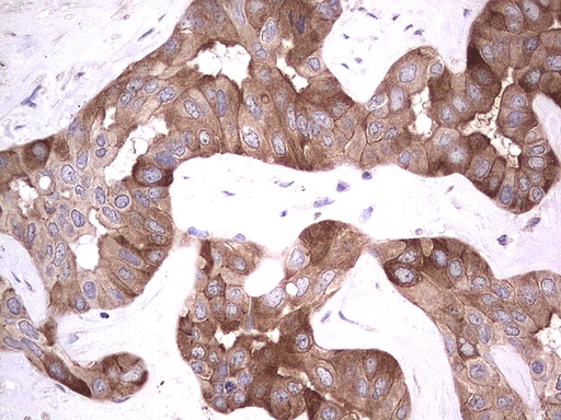 R1 / RRM1 Antibody - Immunohistochemical staining of paraffin-embedded Carcinoma of Human liver tissue using anti-RRM1 mouse monoclonal antibody.  heat-induced epitope retrieval by 1 mM EDTA in 10mM Tris, pH8.5, 120C for 3min)