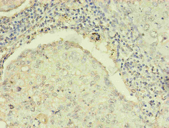 R1 / RRM1 Antibody - Immunohistochemistry of paraffin-embedded human lung cancer using product in 30ug/ml dilute concentrations.
