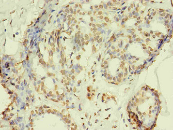 R1 / RRM1 Antibody - Immunohistochemistry of paraffin-embedded human breast cancer using RRM1 Monoclonal Antibody in 30ug/ml dilute concentrations.