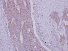R1 / RRM1 Antibody - IHC of paraffin-embedded Colon ca, using RRM1 antibody at 1:500 dilution.