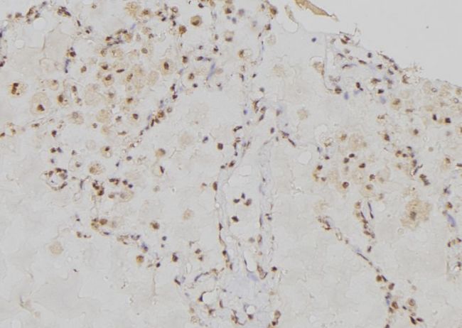 R1 / RRM1 Antibody - 1:100 staining human lung tissue by IHC-P. The sample was formaldehyde fixed and a heat mediated antigen retrieval step in citrate buffer was performed. The sample was then blocked and incubated with the antibody for 1.5 hours at 22°C. An HRP conjugated goat anti-rabbit antibody was used as the secondary.
