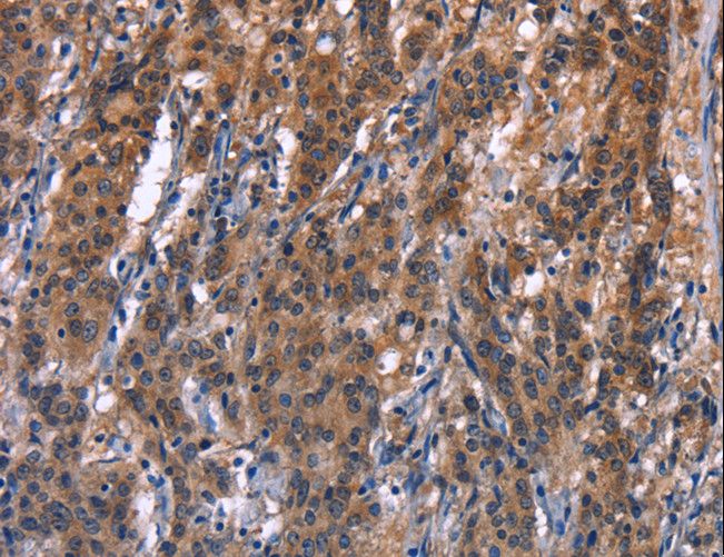 R3HCC1L / C10orf28 Antibody - Immunohistochemistry of paraffin-embedded Human gastric cancer using R3HCC1L Polyclonal Antibody at dilution of 1:40.