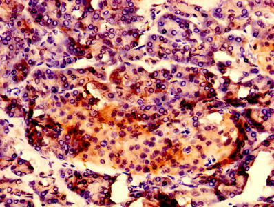 RAB10 Antibody - Immunohistochemistry of paraffin-embedded human colon cancer using RAB10 Antibody at dilution of 1:20