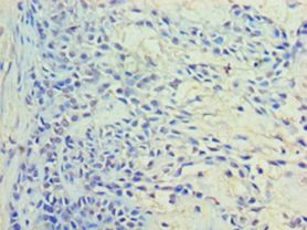 RAB11A Antibody - Immunohistochemistry of paraffin-embedded human breast cancer using antibody at 1:100 dilution.  This image was taken for the unconjugated form of this product. Other forms have not been tested.
