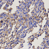 RAB11A Antibody - Immunohistochemistry of paraffin-embedded mouse lung cancer using RAB11A antibody at dilution of 1:200 (x400 lens)