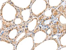 RAB11A Antibody - Immunohistochemistry of paraffin-embedded Human thyroid cancer tissue  using RAB11A Polyclonal Antibody at dilution of 1:45(×200)