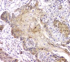 RAB11B Antibody - IHC staining of FFPE human esophageal squamous cancer with RAB11B antibody at 1ug/ml. HIER: boil tissue sections in pH6, 10mM citrate buffer, for 10-20 min and allow to cool before testing.
