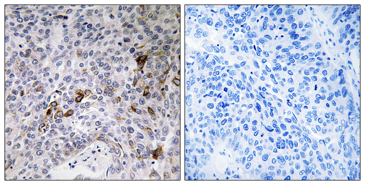 RAB11FIP3 Antibody - Immunohistochemistry analysis of paraffin-embedded human lung carcinoma tissue, using RAB11FIP3 Antibody. The picture on the right is blocked with the synthesized peptide.