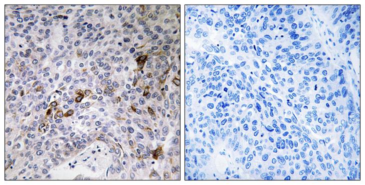 RAB11FIP3 Antibody - Peptide - + Immunohistochemistry analysis of paraffin-embedded human lung carcinoma tissue using RAB11FIP3 antibody.