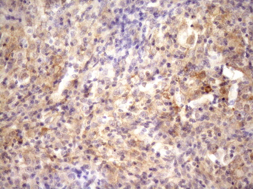 RAB11FIP4 / RAB11-FIP4 Antibody - Immunohistochemical staining of paraffin-embedded Carcinoma of Human bladder tissue using anti-RAB11FIP4 mouse monoclonal antibody. (Heat-induced epitope retrieval by Tris-EDTA, pH8.0)(1:150)