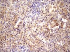 RAB11FIP4 / RAB11-FIP4 Antibody - Immunohistochemical staining of paraffin-embedded Carcinoma of Human bladder tissue using anti-RAB11FIP4 mouse monoclonal antibody. (Heat-induced epitope retrieval by Tris-EDTA, pH8.0)(1:150)