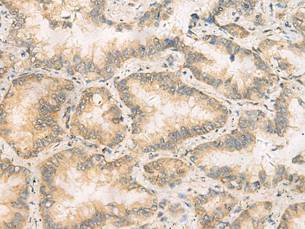 RAB13 Antibody - Immunohistochemistry of paraffin-embedded Human lung cancer tissue  using RAB13 Polyclonal Antibody at dilution of 1:50(×200)