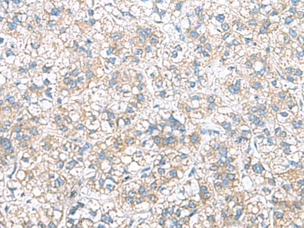 RAB13 Antibody - Immunohistochemistry of paraffin-embedded Human liver cancer tissue  using RAB13 Polyclonal Antibody at dilution of 1:50(×200)