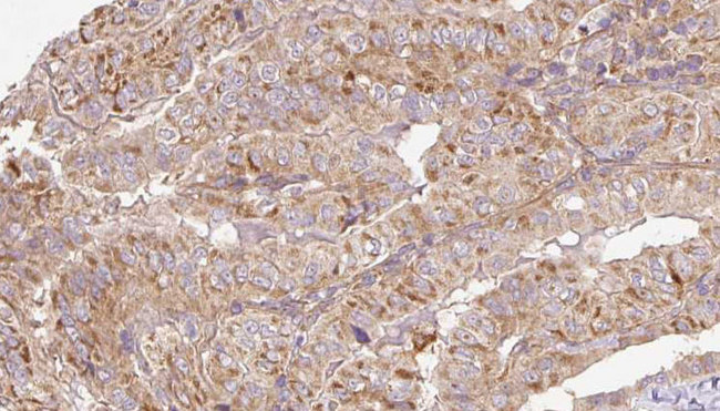 RAB14 Antibody - 1:100 staining human thyroid carcinoma tissue by IHC-P. The sample was formaldehyde fixed and a heat mediated antigen retrieval step in citrate buffer was performed. The sample was then blocked and incubated with the antibody for 1.5 hours at 22°C. An HRP conjugated goat anti-rabbit antibody was used as the secondary.