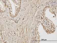 RAB17 Antibody - Immunoperoxidase of monoclonal antibody to RAB17 on formalin-fixed paraffin-embedded human prostate. [antibody concentration 3 ug/ml]