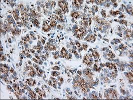 RAB17 Antibody - IHC of paraffin-embedded Carcinoma of Human liver tissue using anti-RAB17 mouse monoclonal antibody. (Dilution 1:50).