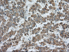 RAB17 Antibody - IHC of paraffin-embedded Carcinoma of Human liver tissue using anti-RAB17 mouse monoclonal antibody. (Dilution 1:50).