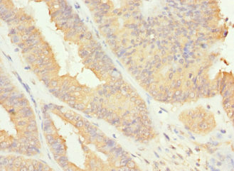 RAB17 Antibody - Immunohistochemistry of paraffin-embedded human endometrial cancer at dilution 1:100