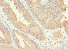 RAB17 Antibody - Immunohistochemistry of paraffin-embedded human endometrial cancer at dilution 1:100