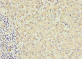 RAB17 Antibody - Immunohistochemistry of paraffin-embedded human liver cancer at dilution 1:100