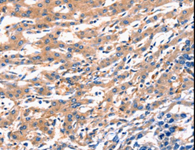 RAB18 Antibody - Immunohistochemistry of paraffin-embedded Human liver cancer using RAB18 Polyclonal Antibody at dilution of 1:300.