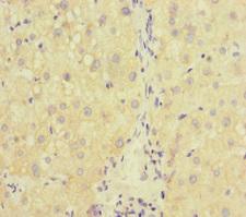 RAB18 Antibody - Immunohistochemistry of paraffin-embedded human liver cancer at dilution of 1:100