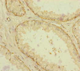 RAB18 Antibody - Immunohistochemistry of paraffin-embedded human prostate cancer at dilution of 1:100