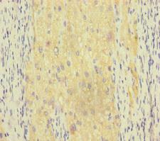 RAB18 Antibody - Immunohistochemistry of paraffin-embedded human liver cancer at dilution of 1:100