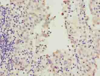 RAB20 Antibody - Immunohistochemistry of paraffin-embedded human lung cancer using antibody at dilution of 1:100.