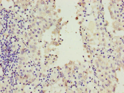RAB20 Antibody - Immunohistochemistry of paraffin-embedded human lung cancer using RAB20 Antibody at dilution of 1:100
