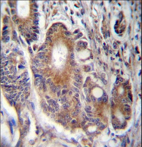 RAB21 Antibody - RAB21 Antibody immunohistochemistry of formalin-fixed and paraffin-embedded human colon carcinoma followed by peroxidase-conjugated secondary antibody and DAB staining.