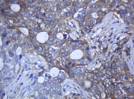 RAB21 Antibody - IHC of paraffin-embedded Adenocarcinoma of Human breast tissue using anti-RAB21 mouse monoclonal antibody.