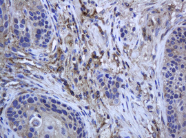 RAB21 Antibody - IHC of paraffin-embedded Carcinoma of Human lung tissue using anti-RAB21 mouse monoclonal antibody.