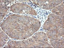 RAB21 Antibody - IHC of paraffin-embedded Adenocarcinoma of Human ovary tissue using anti-RAB21 mouse monoclonal antibody.