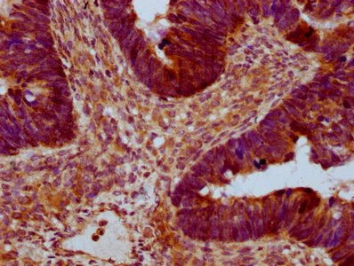 RAB21 Antibody - Immunohistochemistry Dilution at 1:400 and staining in paraffin-embedded human ovarian cancer performed on a Leica BondTM system. After dewaxing and hydration, antigen retrieval was mediated by high pressure in a citrate buffer (pH 6.0). Section was blocked with 10% normal Goat serum 30min at RT. Then primary antibody (1% BSA) was incubated at 4°C overnight. The primary is detected by a biotinylated Secondary antibody and visualized using an HRP conjugated SP system.