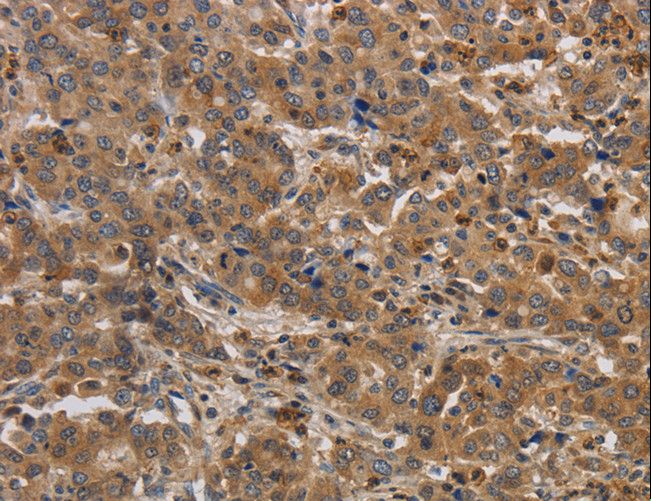 RAB22A / RAB22 Antibody - Immunohistochemistry of paraffin-embedded Human liver cancer using RAB22A Polyclonal Antibody at dilution of 1:20.