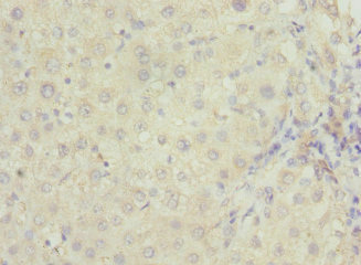 RAB23 Antibody - Immunohistochemistry of paraffin-embedded human liver cancer at dilution 1:100
