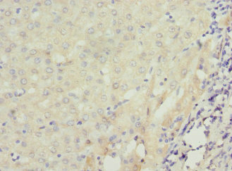 RAB23 Antibody - Immunohistochemistry of paraffin-embedded human liver cancer at dilution 1:100