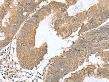 RAB23 Antibody - Immunohistochemistry of paraffin-embedded Human colorectal cancer tissue  using RAB23 Polyclonal Antibody at dilution of 1:50(×200)