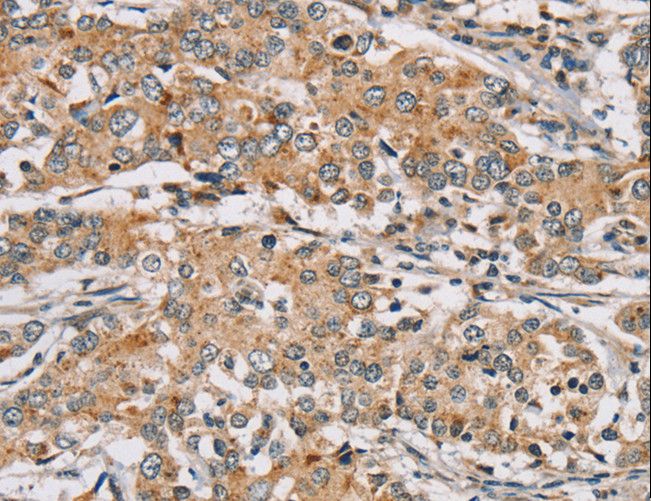 RAB24 Antibody - Immunohistochemistry of paraffin-embedded Human breast cancer using RAB24 Polyclonal Antibody at dilution of 1:45.