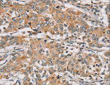 RAB24 Antibody - Immunohistochemistry of paraffin-embedded Human breast cancer using RAB24 Polyclonal Antibody at dilution of 1:45.