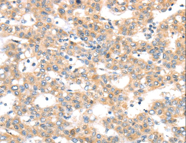 RAB24 Antibody - Immunohistochemistry of paraffin-embedded Human thyroid cancer using RAB24 Polyclonal Antibody at dilution of 1:45.