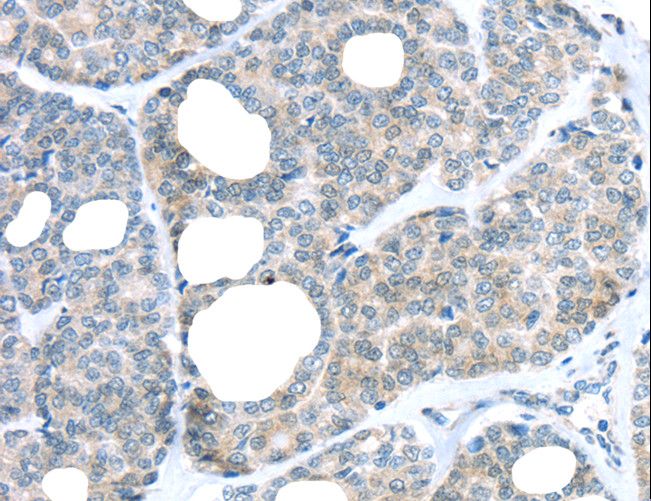 RAB24 Antibody - Immunohistochemistry of paraffin-embedded Human thyroid cancer using RAB24 Polyclonal Antibody at dilution of 1:45.