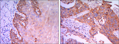 RAB25 Antibody - IHC of paraffin-embedded esophagus tissues (left) and human lung cancer (right) using Rab25 mouse monoclonal antibody with DAB staining.