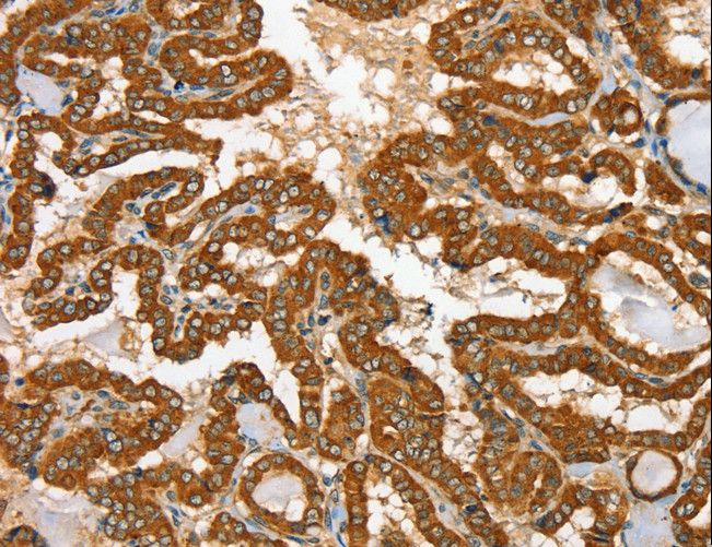 RAB25 Antibody - Immunohistochemistry of paraffin-embedded Human thyroid cancer using RAB25 Polyclonal Antibody at dilution of 1:35.
