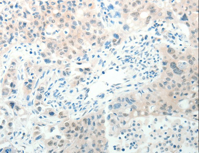 RAB25 Antibody - Immunohistochemistry of paraffin-embedded Human lung cancer using RAB25 Polyclonal Antibody at dilution of 1:50.